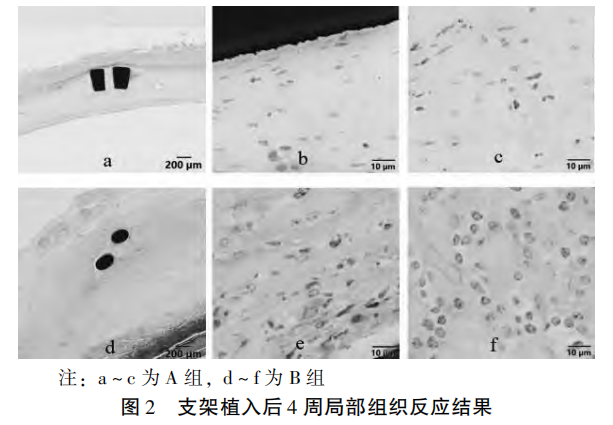 【艾佧醫(yī)學(xué)】鎳鈦合金血管支架植入后再狹窄的組織病理評(píng)價(jià)研究