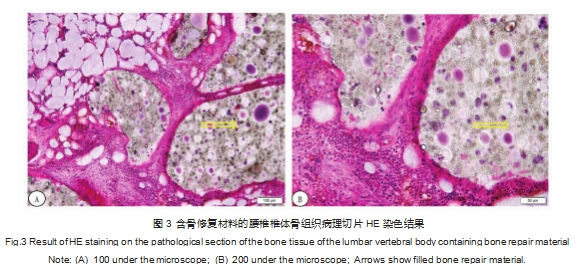 【文章薦讀】植入了骨修復材料的小型豬腰椎椎體不脫鈣病理組織切片制備方法